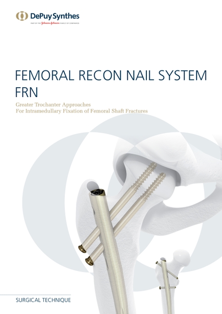 EXPERT Cannulated Lateral Entry Femoral Recon Nail  Products  DePuy  Synthes